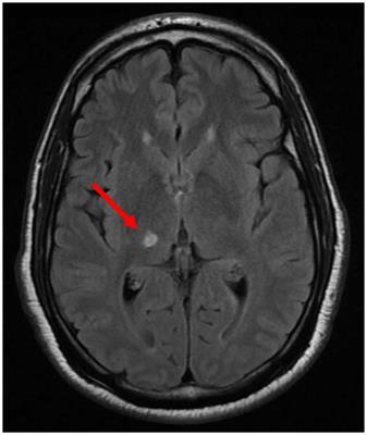 Hyperbaric oxygen therapy for thalamic pain syndrome: case report